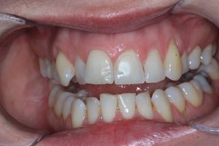 Veneers before