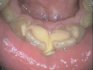 Dental Clean 2 - Before