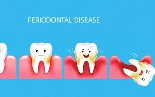 periondontal disease