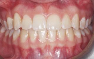 Invisalign transformation 001 (after)