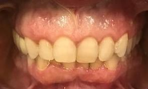 Braces and Invisalign -Before