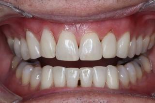 Teeth Whitening 1 - After