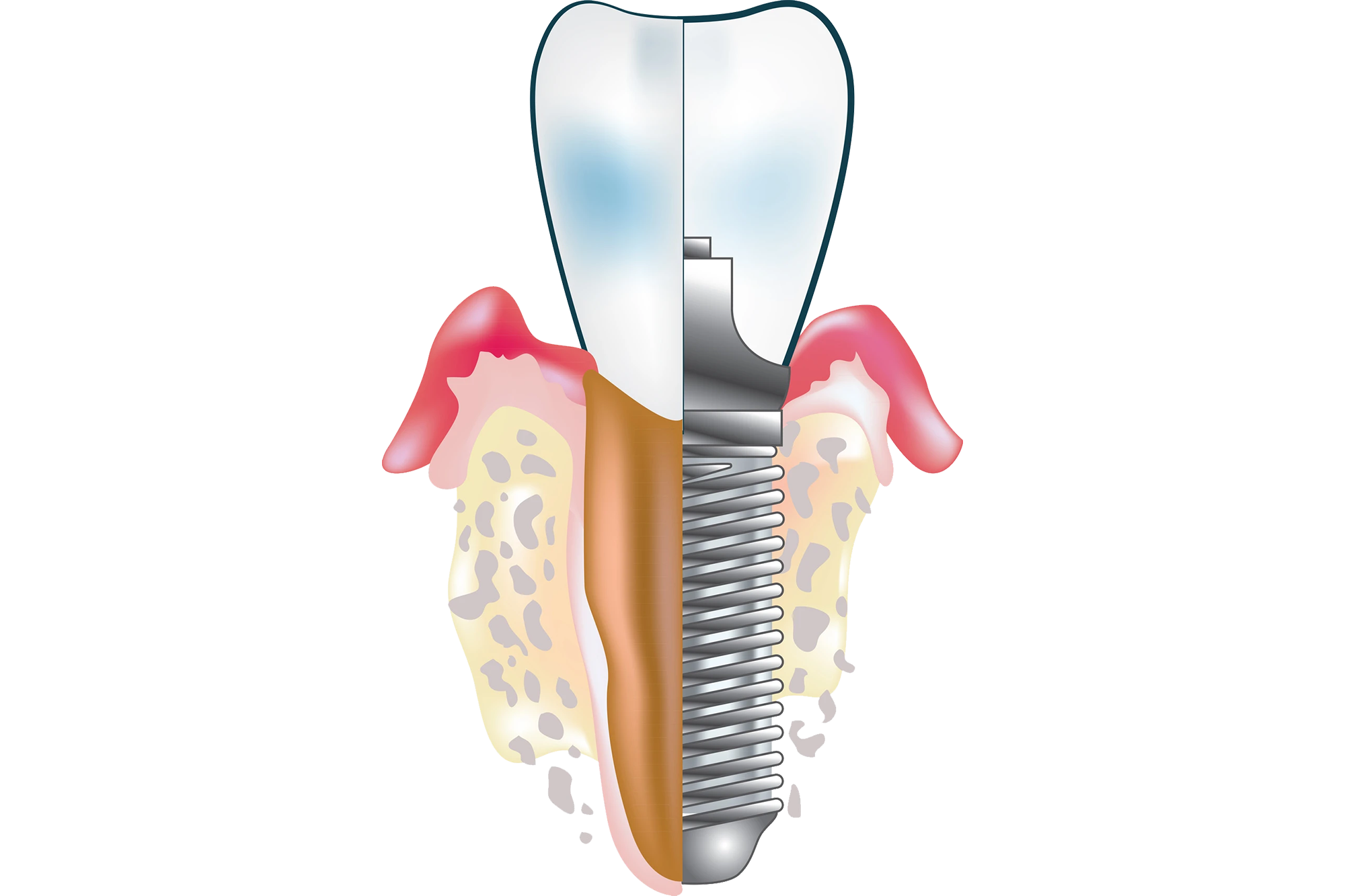 What are dental implants?