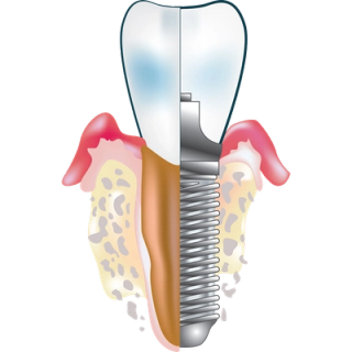 What are dental implants?