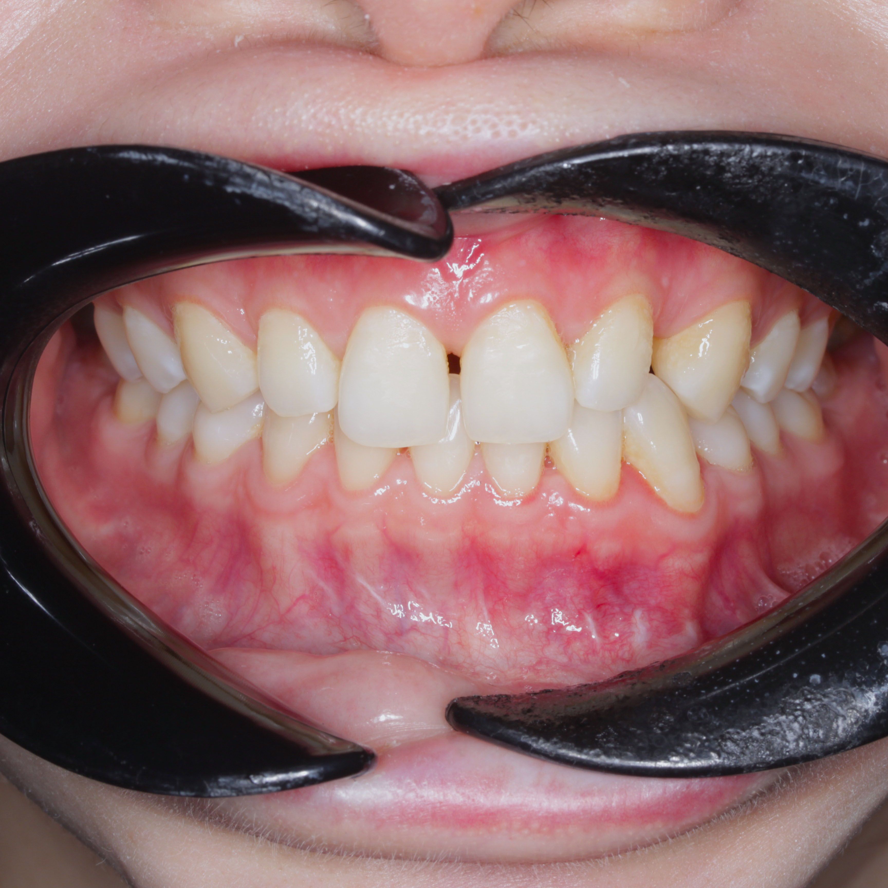 Porcelain Veneers Before