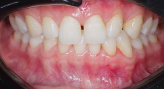 Porcelain Veneers Before