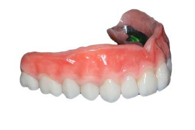 Conventional dentures