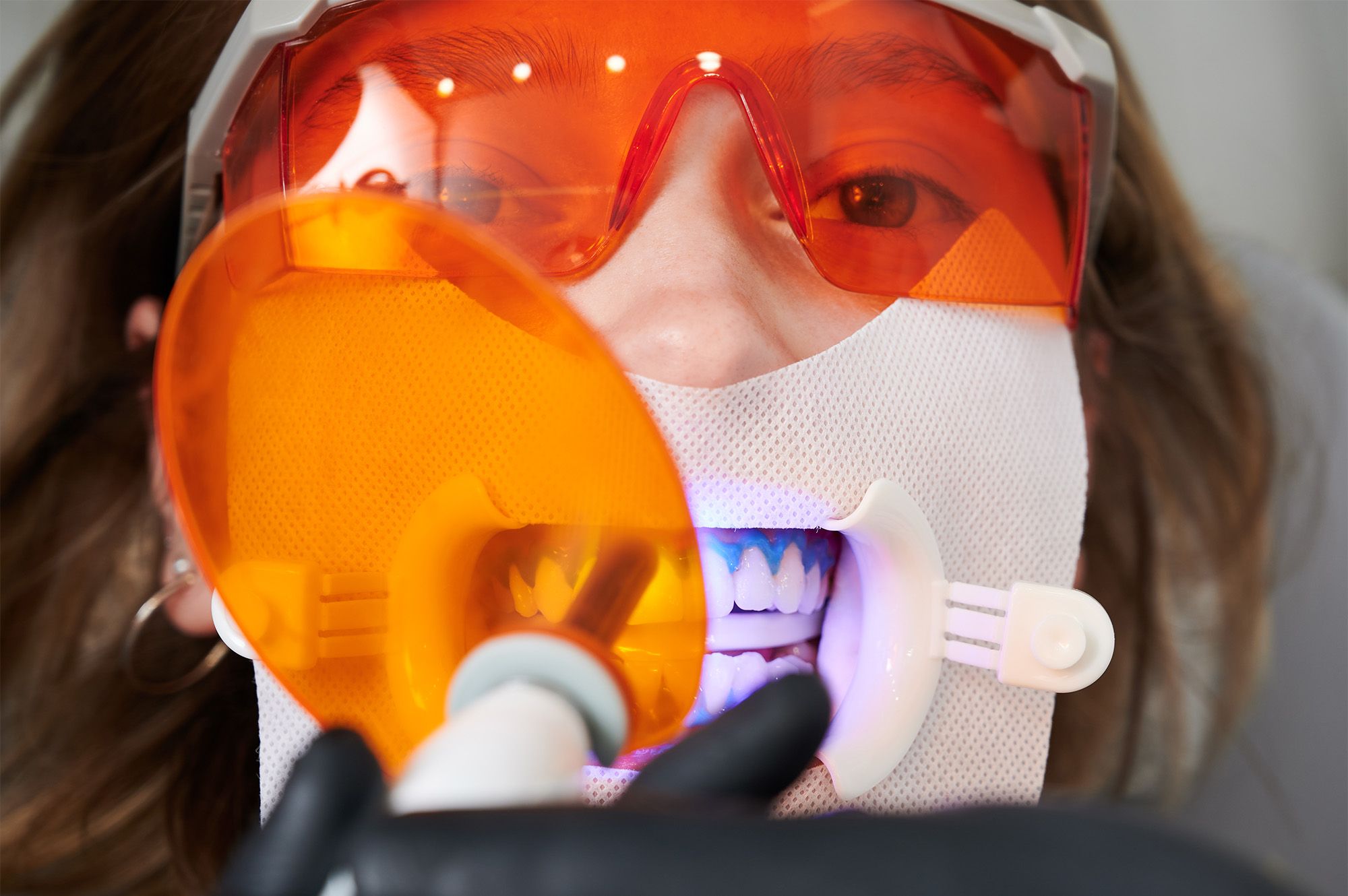 In-Chair Whitening — Results in a Single Appointment
