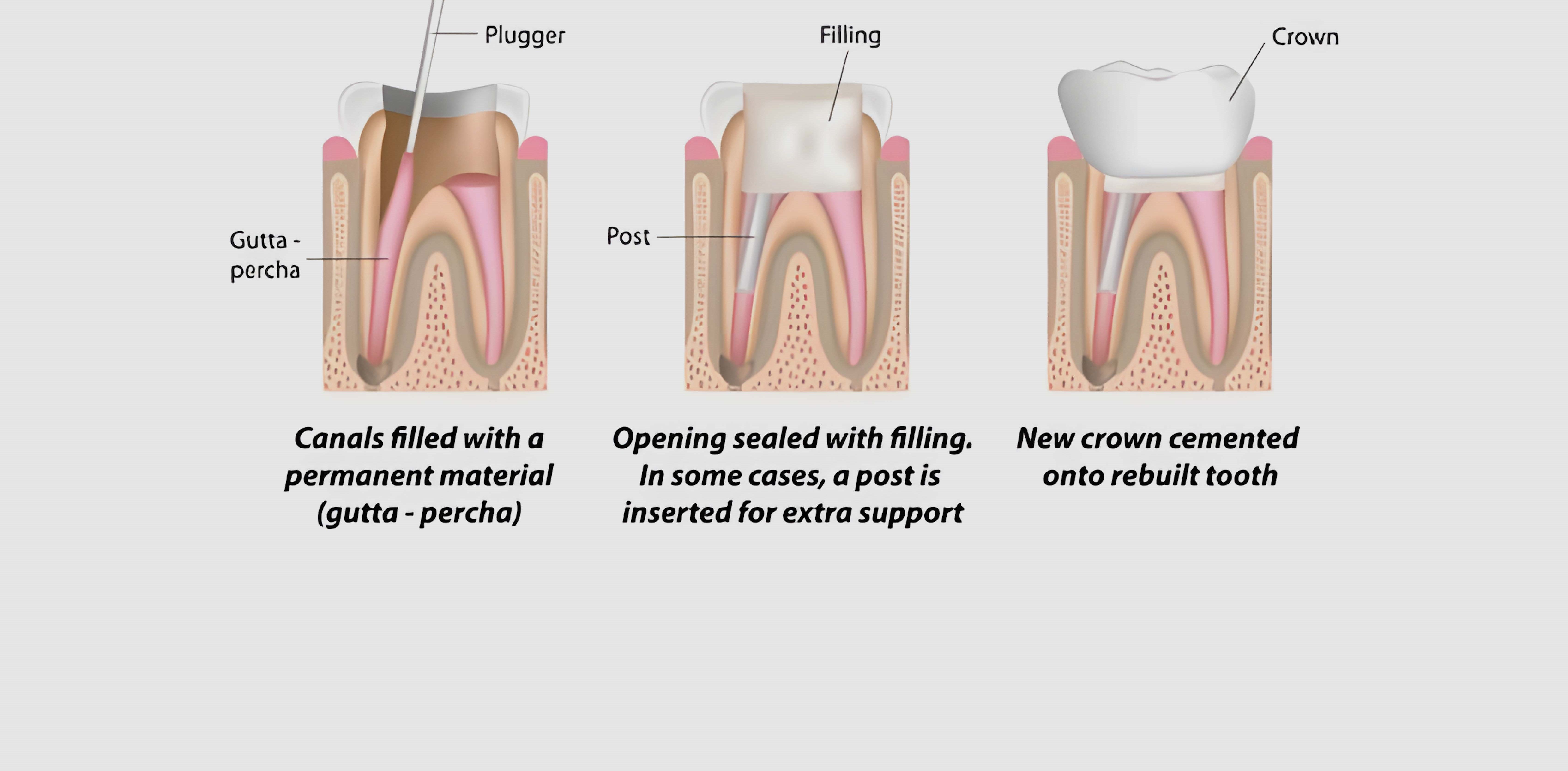 What to Expect during the Root Canal Procedure? 2