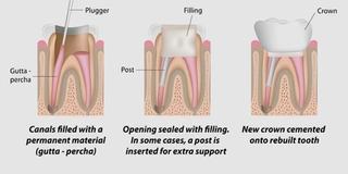What to Expect during the Root Canal Procedure? 2