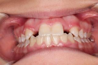 Dental Crown 1 - Before