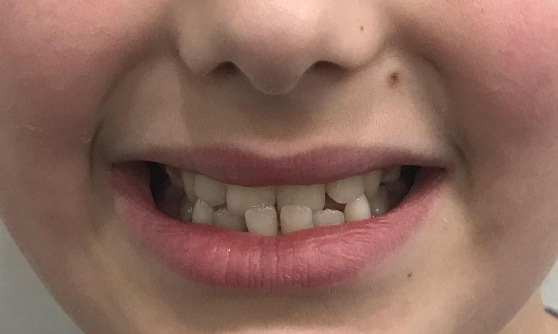 Braces and Invisalign - Before