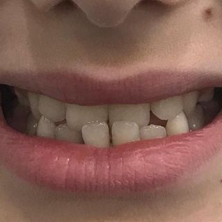 Braces and Invisalign - Before