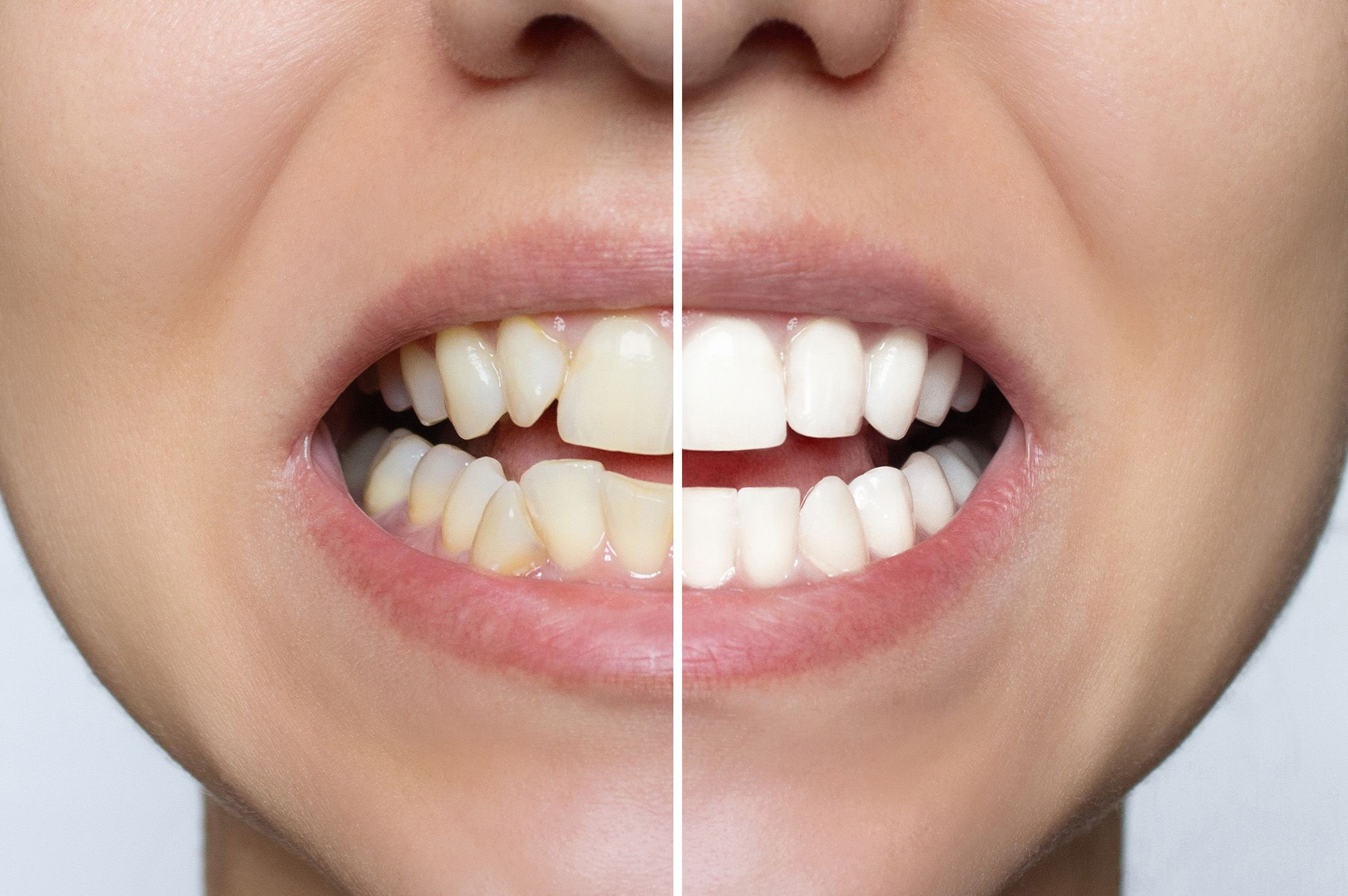 Uneven Teeth