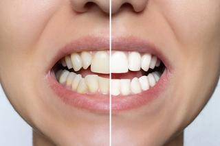 Uneven Teeth