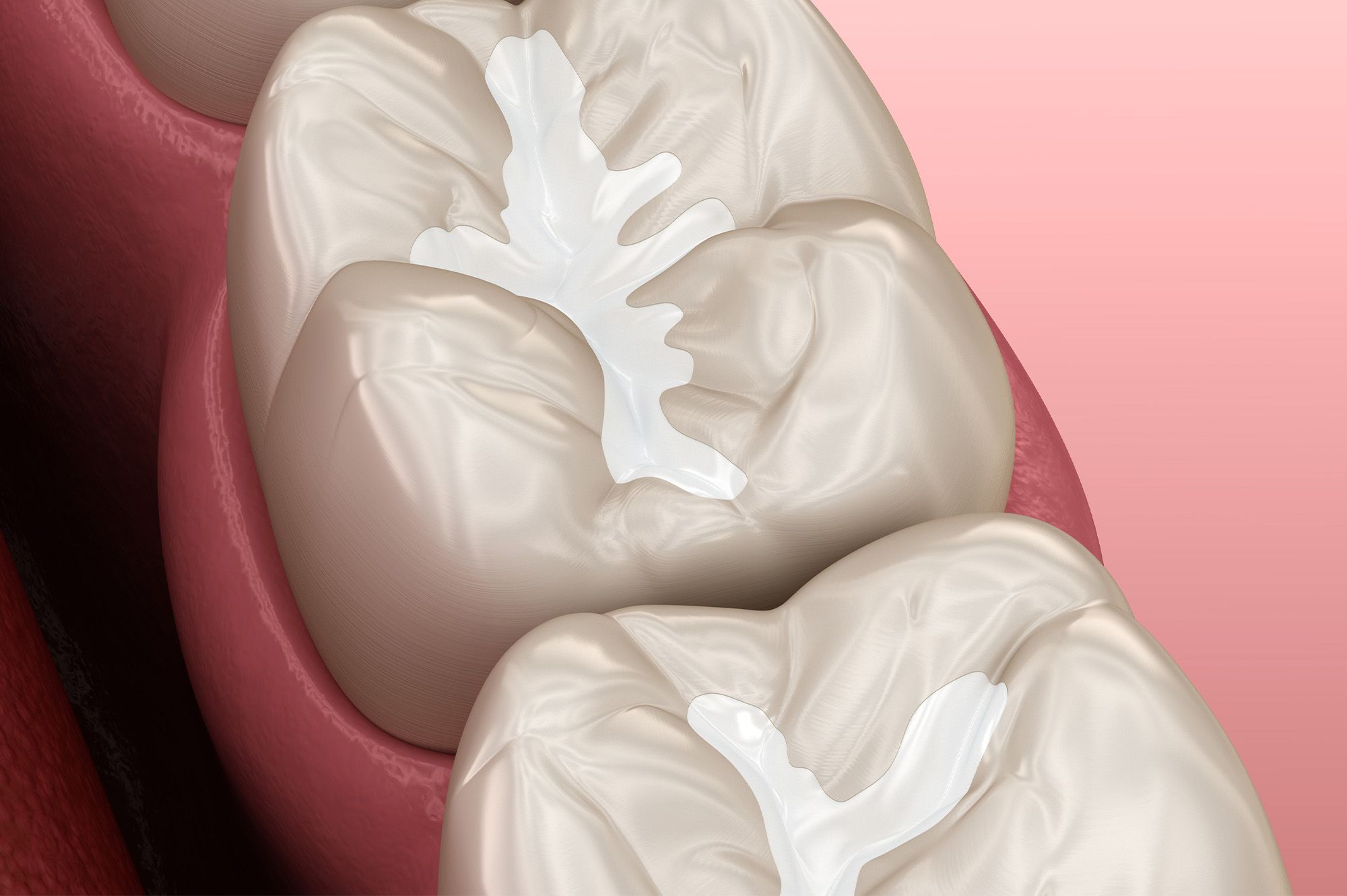 Dental fissure sealants