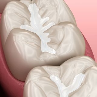 Dental fissure sealants