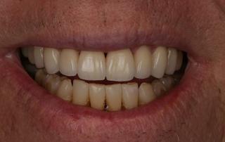 After image of a Crown and Bridge on a patient.