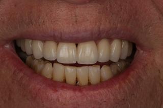 Michael after crown and bridge treatment.