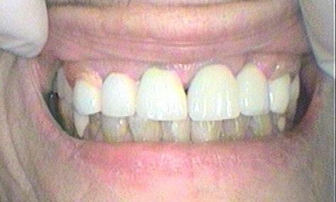 Crowns and Bridges - Before