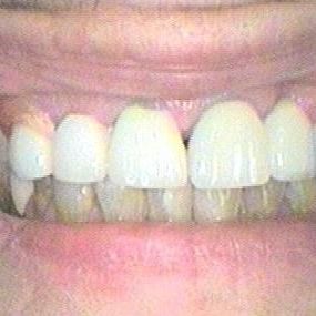Crowns and Bridges - Before