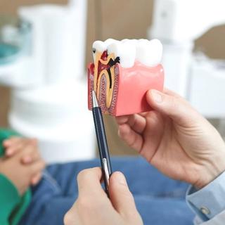 What Is a Root Canal?