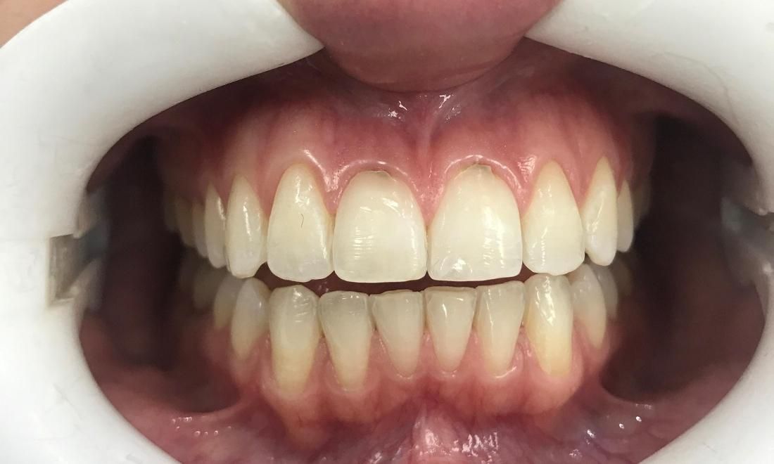 Braces and Invisalign - After