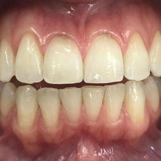 Braces and Invisalign - After