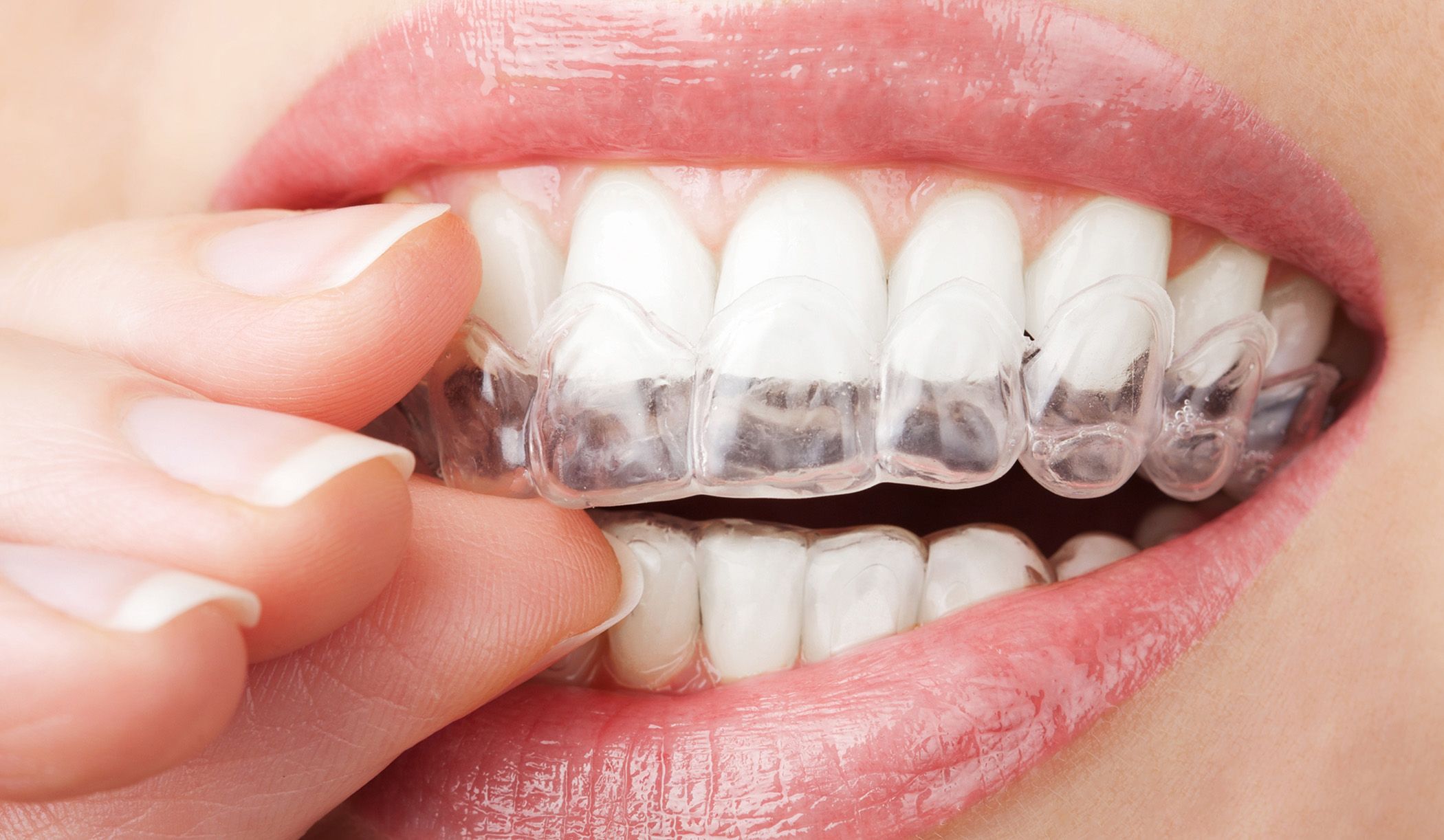 Image of a close up of a person putting on their Invisalign retainers.