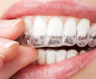 Invisalign® is becoming increasingly popular for orthodontics worldwide.