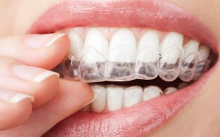 Image of a close up of a person putting on their Invisalign retainers.