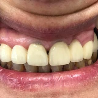Crowns and Bridges - After