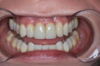 Orthodontics, Root Coverage Gum Grafting and Implants after