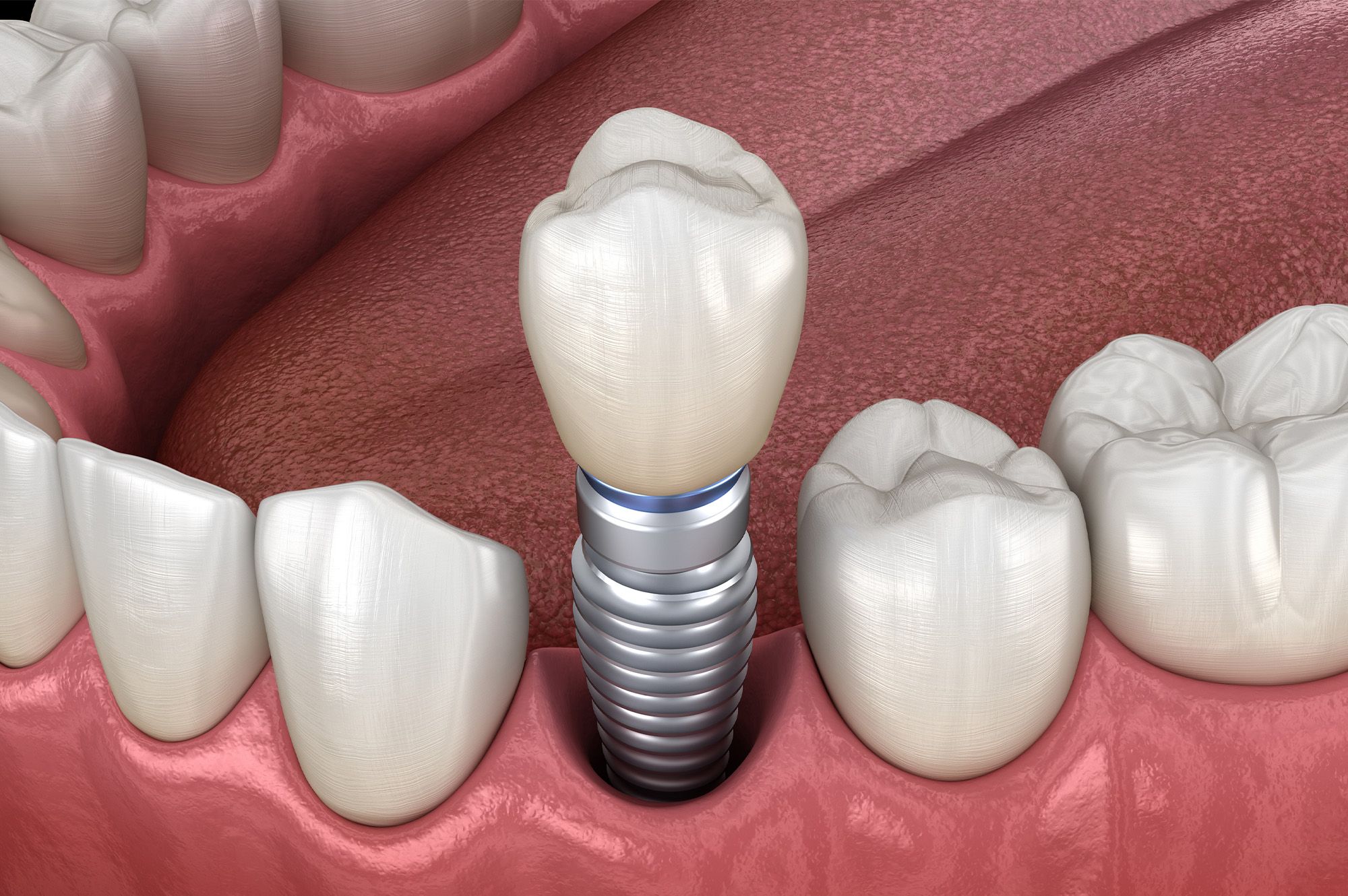 Single tooth