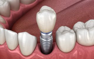 Single Dental Implants