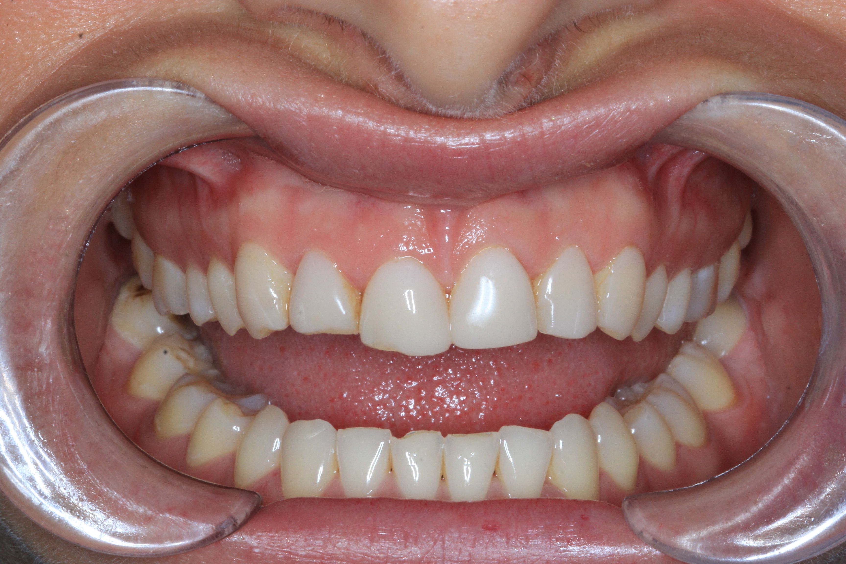 before smile design
