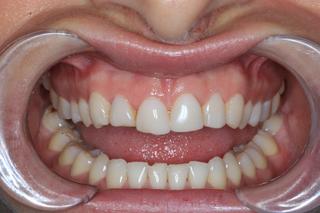 before smile design