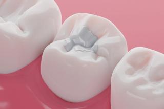 What Are White Fillings?