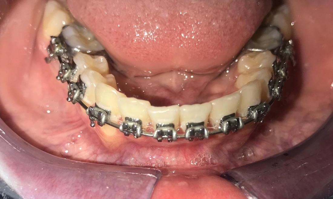 Braces and Invisalign - After