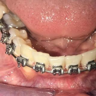Braces and Invisalign - After