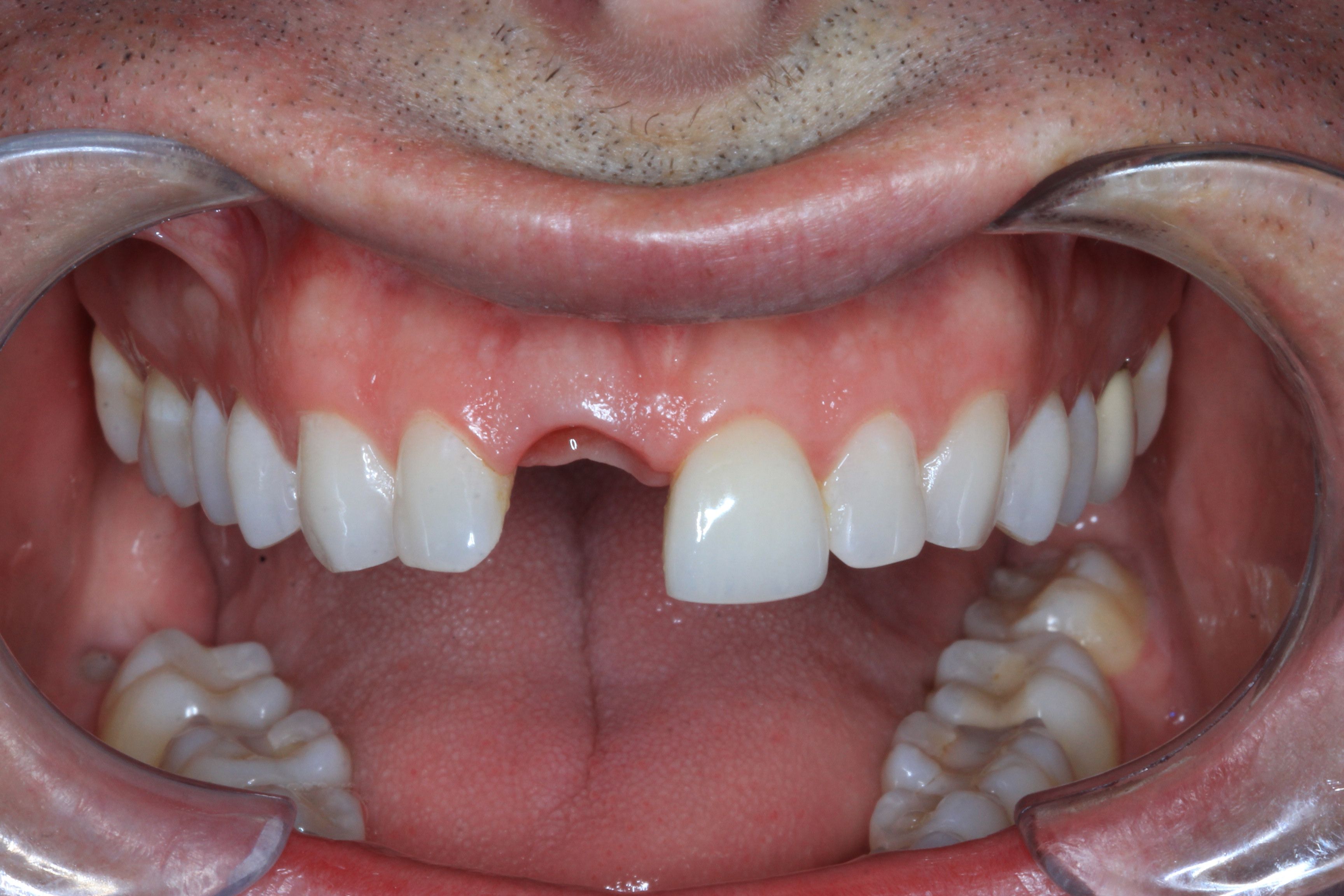 before implant