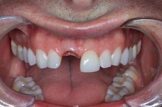 before implant