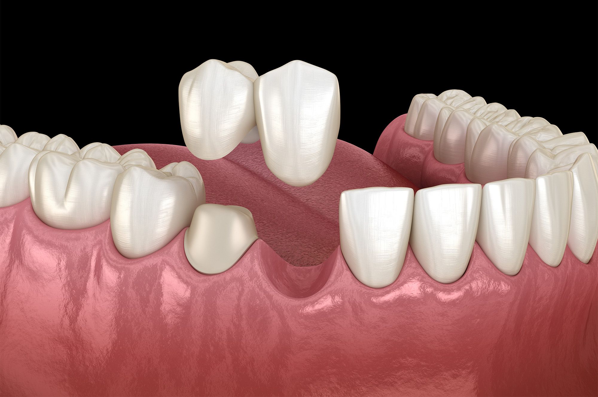 Cantilever Dental Bridge
