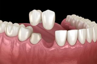 Cantilever Dental Bridge