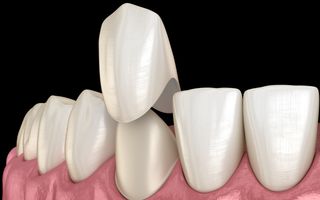 Image of a 3D demonstration of a dental crown and how it is applied.