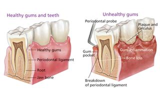 image of how periostitis affects the healthy gums and teeth.