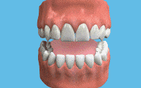 Bruxism is the technical term for grinding your teeth; using the forces of your bite and the movement and clenching of opposing teeth
