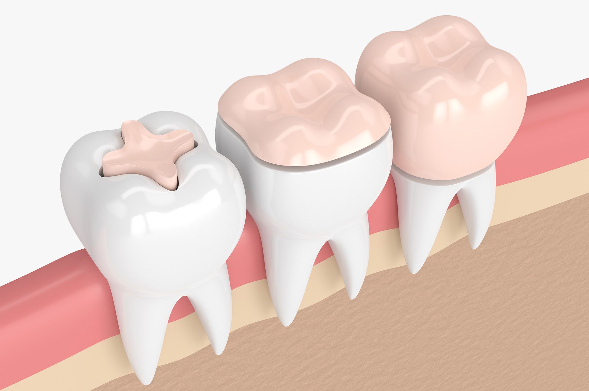 What are inlays and onlays?