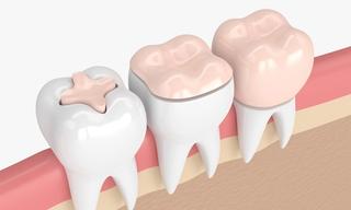 What are inlays and onlays?