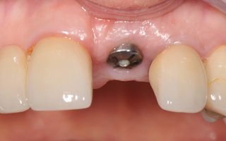 An example of a dental implants in Richmond, Melbourne.